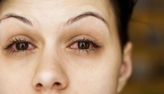 Bulaşıcı “kırmızı göz” hastalığı alarma geçti!  Hızla yayılıyor: Vaka sayısı 7 bin 500'ü aştı