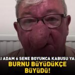 Burnu büyüdükçe büyüdü! 68 yaşındaki adam kabusu yaşadı! 4 saatlik operasyonla adeta yeniden doğdu