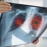 Akciğer Kanseri Geç Teşhis Ediliyor: Hastaların %60’ında Hastalık İleri Aşamada Belirleniyor