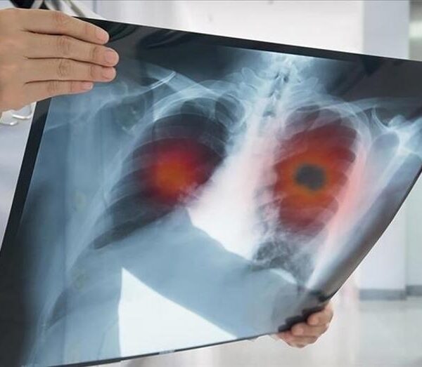 Akciğer Kanseri Geç Teşhis Ediliyor: Hastaların %60’ında Hastalık İleri Aşamada Belirleniyor