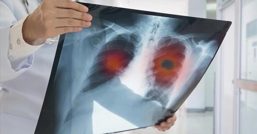 Akciğer Kanseri Geç Teşhis Ediliyor: Hastaların %60’ında Hastalık İleri Aşamada Belirleniyor